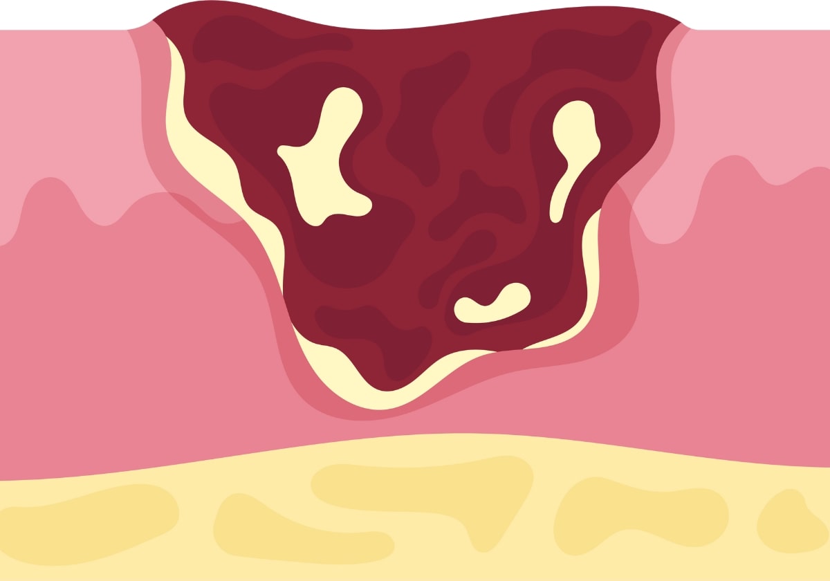 Fistula in Ano in piles by Dr Nazrul Islam
