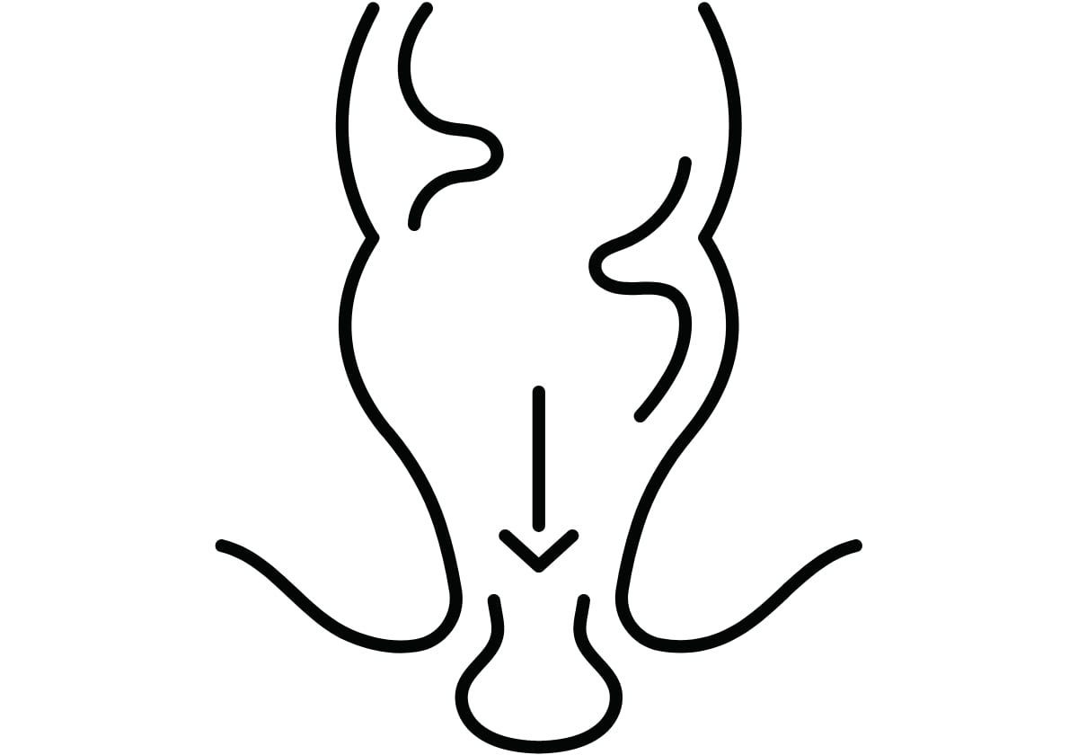 Rectal-Prolapse in piles by Dr Nazrul Islam