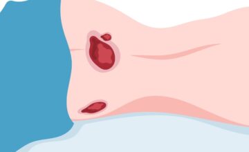 Pilonidal-Sinus in piles by Dr Nazrul Islam